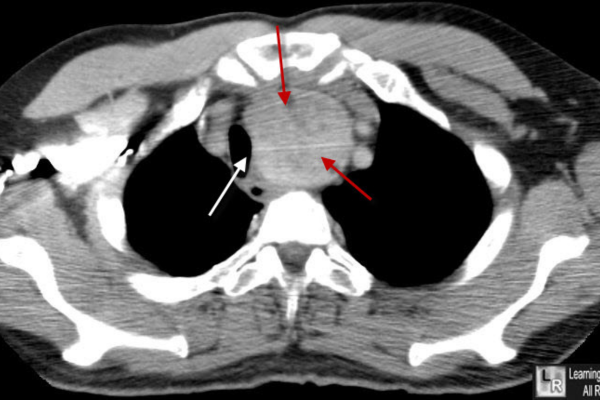 Goitres Dr Francis Hall   CT Scan Axial View Retrosternal Goitre 